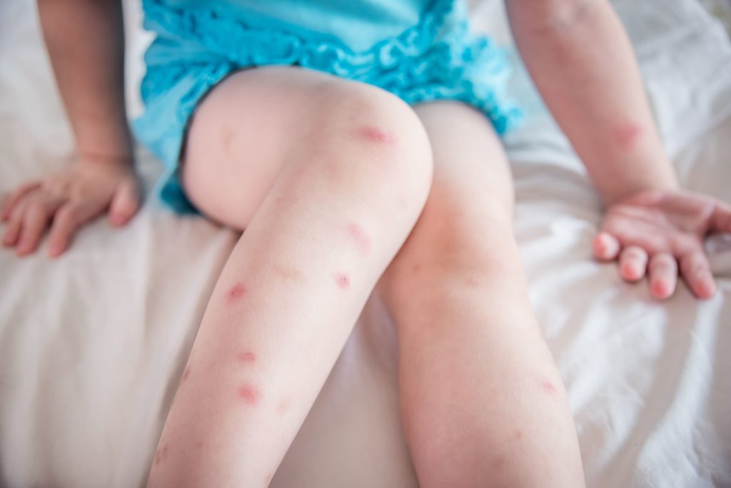 小孩手腳佈滿蚊蟲叮咬的紅疤，兒童防蚊液如何挑選與使用