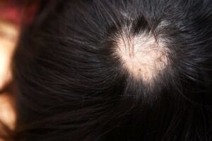 圓形禿的特徵樣貌是頭皮上出現一個或多個圓形的禿斑